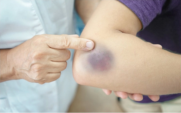 Xuất huyết bầm tím trên cơ thể - cảnh báo điều gì? - Bệnh viện Đa khoa Thái Bình